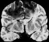 Bilateral venous infarcts secondary to superior sagittal sinus thrombosis